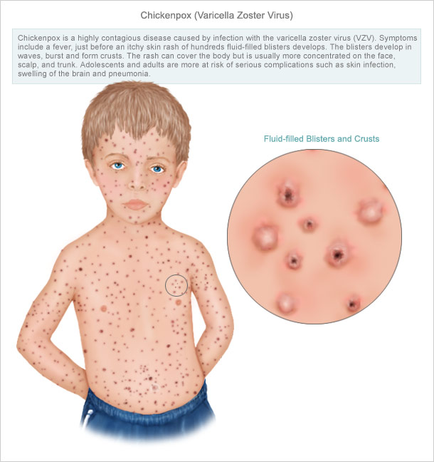 Shingles - Pictures, Symptoms, Causes, Treatment, Contagious